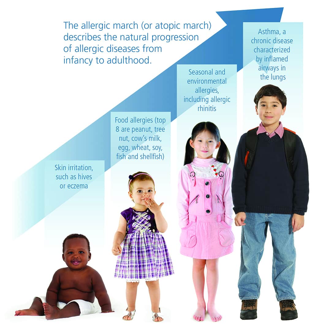 Graphic chart showing the stages of the allergist march with four children of different ages , from baby to pre-teen
