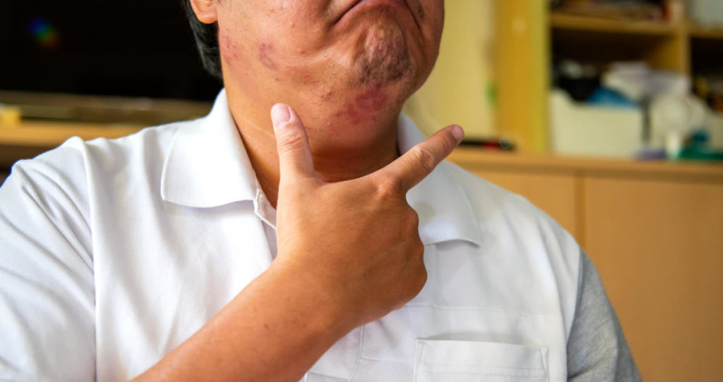 他的下巴和脸颊上有罕见的荨麻疹。他把手举到下巴，表示他的不适。