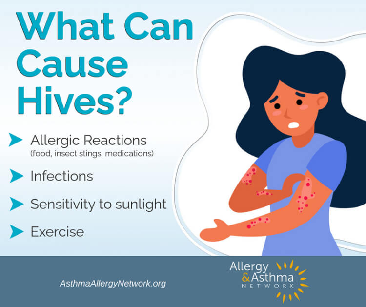 Infographic of what can cause hives: allergic reactions, allergies, sunlight, exercise.