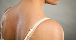 女人背部的上半部分，从一个轻微的侧面角度显示她的荨麻疹不会消失。